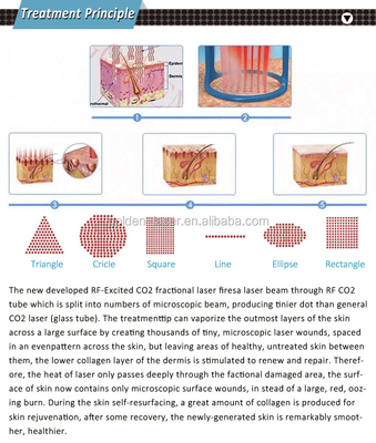 อลูมิเนียมเคส เครื่องเลเซอร์ CO2 ที่มีความสามารถในการฟื้นผิว